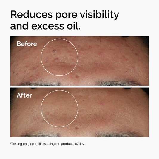 The Ordinary Niacinamide 10% + Zinc 1% Smoothing Serum for Blemish Prone Skin